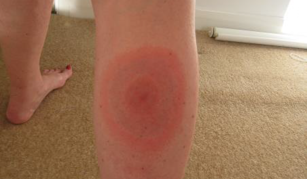 Tick bite